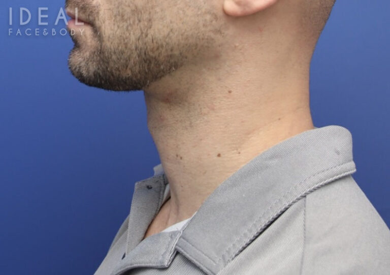 After Image: Awake Chin, Neck Liposculpting | PRECISION SCULPT® | Male - left-side