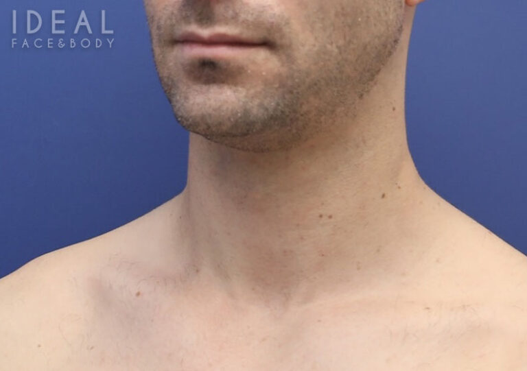 Before Image: Awake Chin, Neck Liposculpting | PRECISION SCULPT® | Male - left-front-oblique