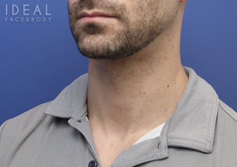 After Image: Awake Chin, Neck Liposculpting | PRECISION SCULPT® | Male - left-front-oblique