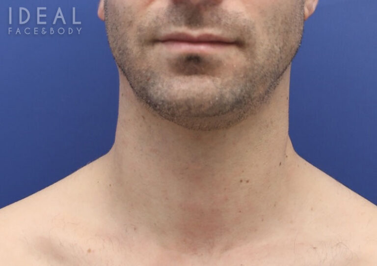 Before Image: Awake Chin, Neck Liposculpting | PRECISION SCULPT® | Male - front