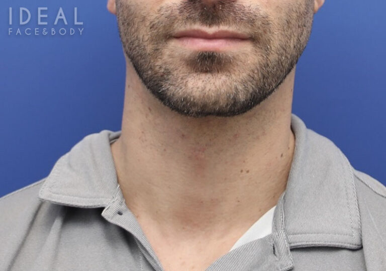 After Image: Awake Chin, Neck Liposculpting | PRECISION SCULPT® | Male - front