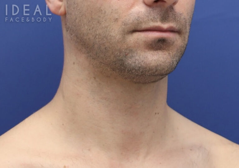 Before Image: Awake Chin, Neck Liposculpting | PRECISION SCULPT® | Male - 