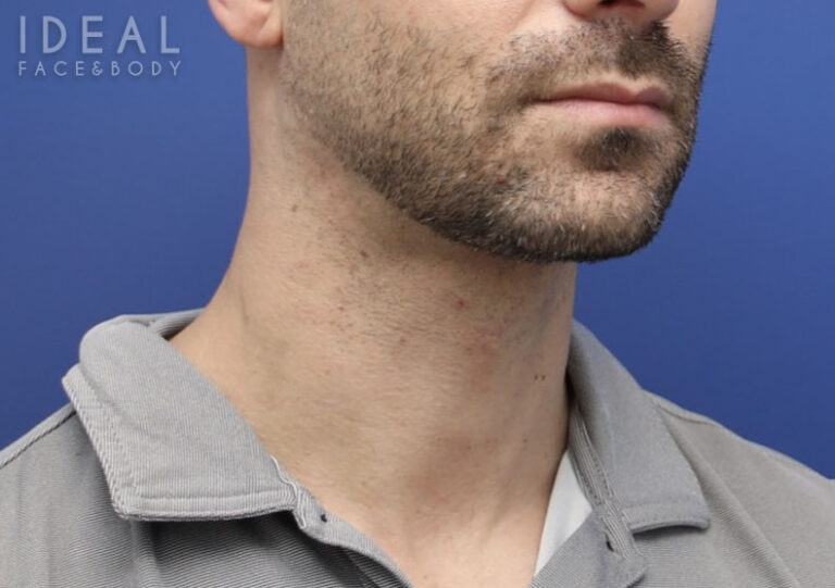 After Image: Awake Chin, Neck Liposculpting | PRECISION SCULPT® | Male - 