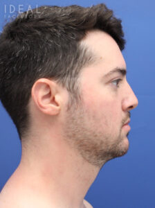 Before Image: Awake Chin, Neck, & Jawline Liposculpting | PRECISION SCULPT®