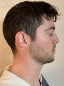 After Image: Awake Chin, Neck, & Jawline Liposculpting | PRECISION SCULPT®