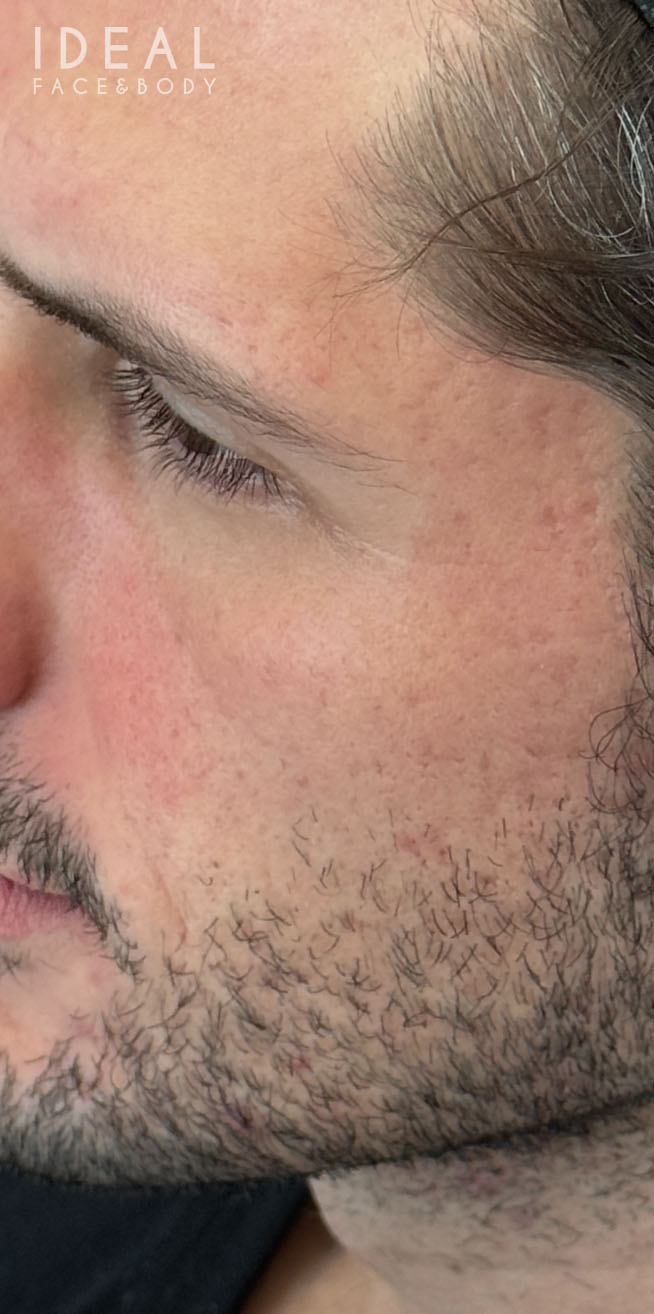 After Image: CO2 Laser Resurfacing - left-side