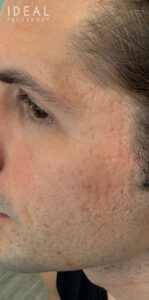 Before Image: CO2 Laser Resurfacing