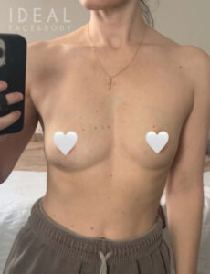 After Image: Awake Breast Fat Transfer After Explant | Raise Your Cup®