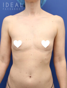 Before Image: Awake Breast Fat Transfer After Explant | Raise Your Cup®