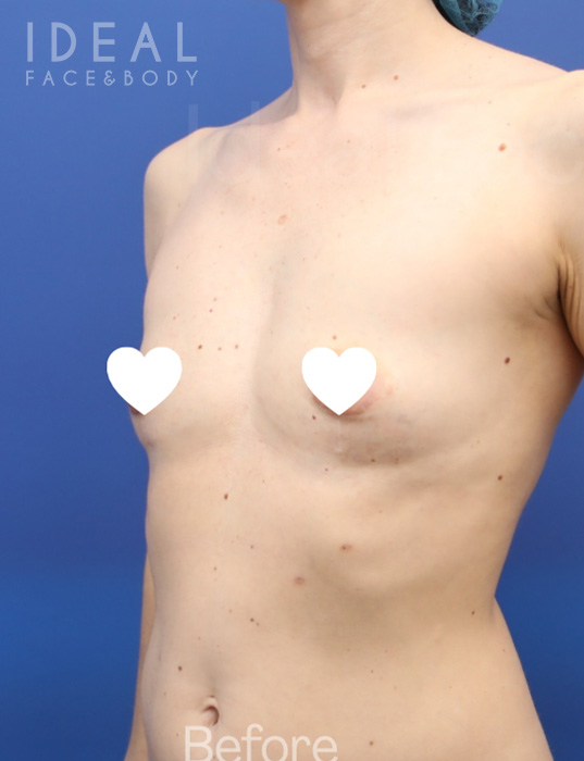 Before Image: Awake Breast Fat Transfer After Explant | Raise Your Cup® - left-front-oblique