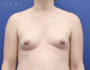 Before Image: Awake Breast Fat Transfer | Raise Your Cup®