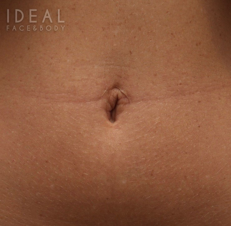 Before Image: Belly Button Repair | Umbilicoplasty - front