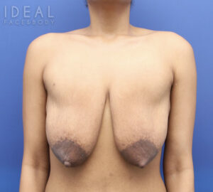 Before Image: Awake Breast Lift® | Mini Anchor