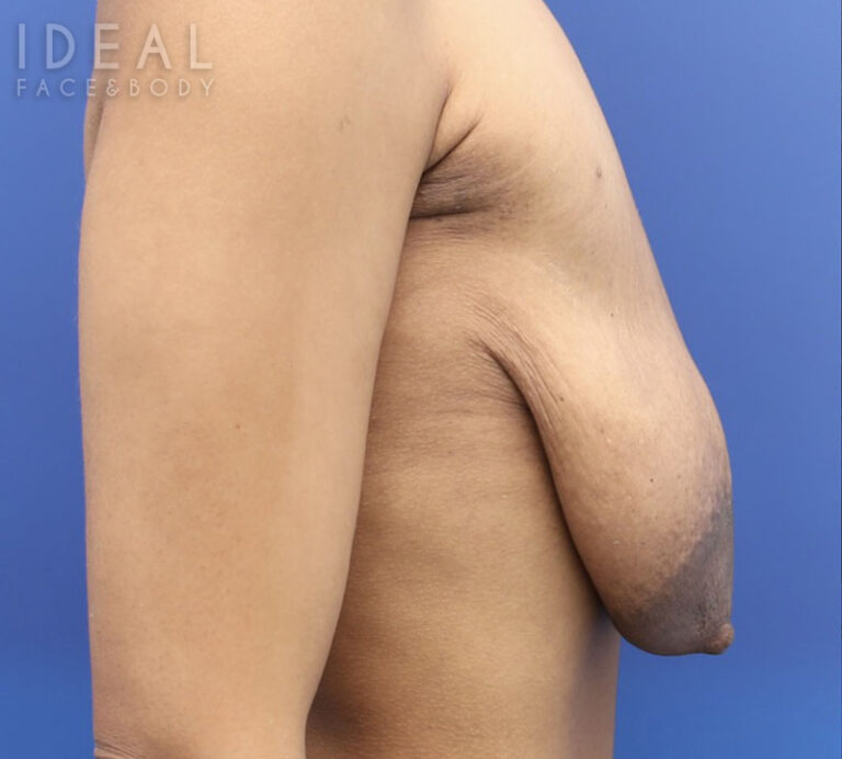 Before Image: Awake Breast Lift® | Mini Anchor - right-side