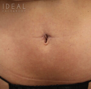 After Image: Belly Button Repair | Umbilicoplasty