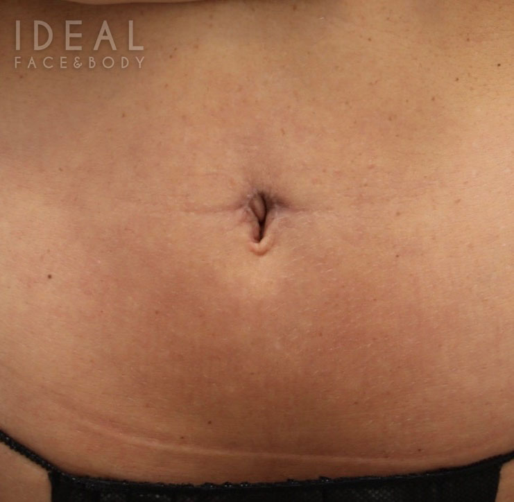 After Image: Belly Button Repair | Umbilicoplasty - front