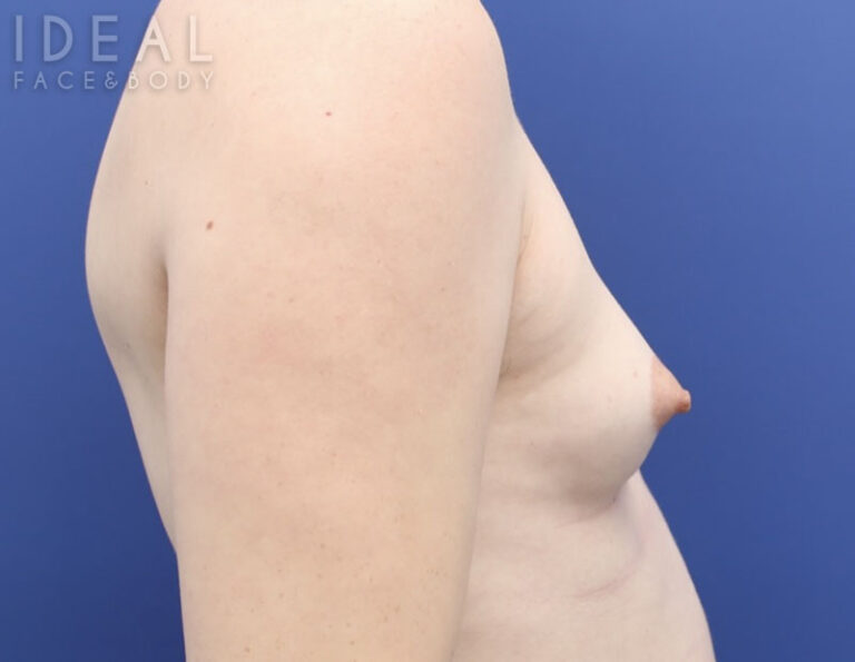 Before Image: Awake Breast Fat Transfer | Raise Your Cup® - right-side