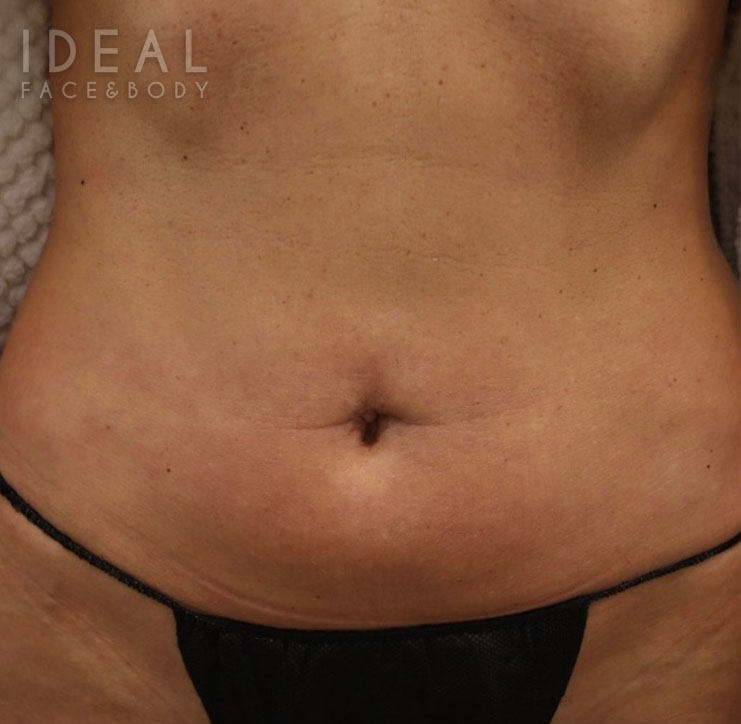 After Image: Belly Button Repair | Umbilicoplasty - front