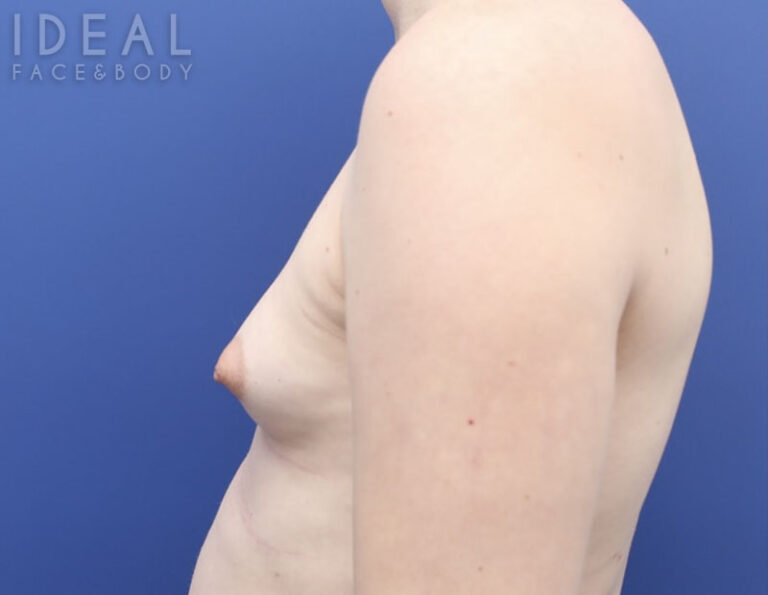 Before Image: Awake Breast Fat Transfer | Raise Your Cup® - left-side