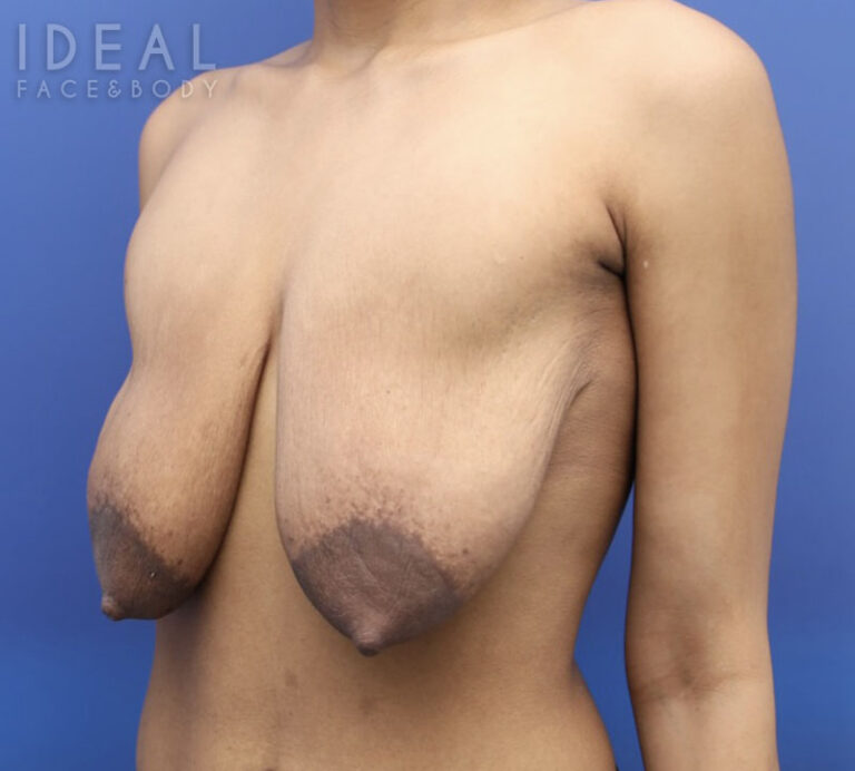 Before Image: Awake Breast Lift® | Mini Anchor - left-front-oblique