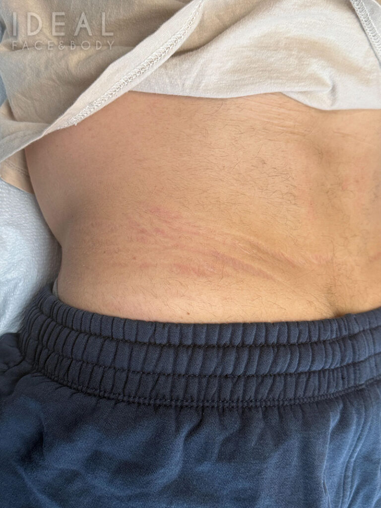 After Image: CO2 Laser for Acne Scarring - front