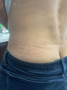 Before Image: CO2 Laser for Acne Scarring