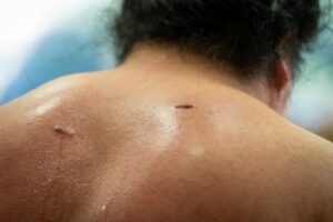 tattoo excision before and after