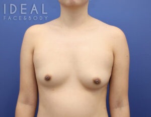 Before Image: Awake Breast Fat Transfer | Raise Your Cup®