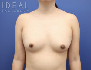 After Image: Awake Breast Fat Transfer | Raise Your Cup®