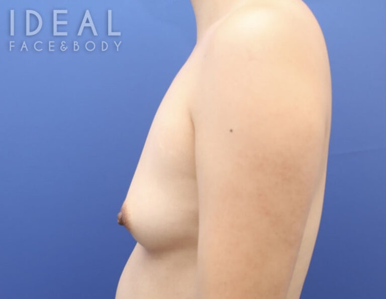 Before Image: Awake Breast Fat Transfer | Raise Your Cup® - left-side