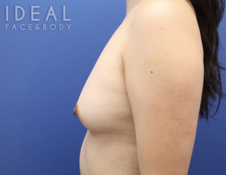 After Image: Awake Breast Fat Transfer | Raise Your Cup® - left-side