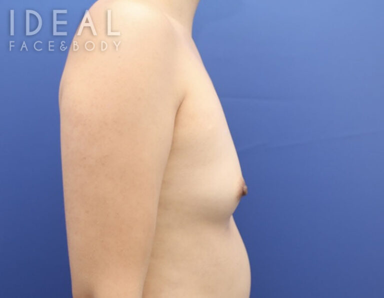 Before Image: Awake Breast Fat Transfer | Raise Your Cup® - right-side