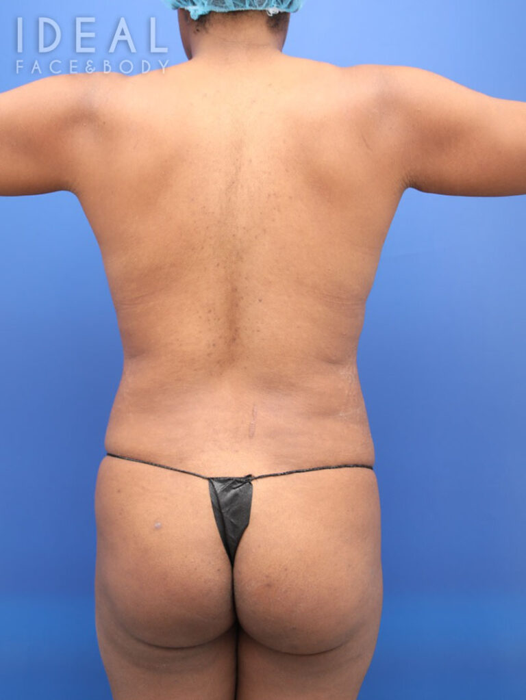Before Image: Awake 360 Liposuction | PRECISION SCULPT® - back