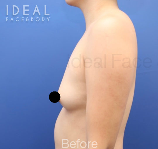 Before Image: Awake Breast Fat Transfer | Raise Your Cup® - left-side