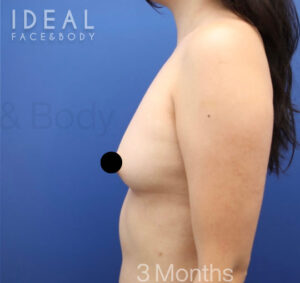 After Image: Awake Breast Fat Transfer | Raise Your Cup®