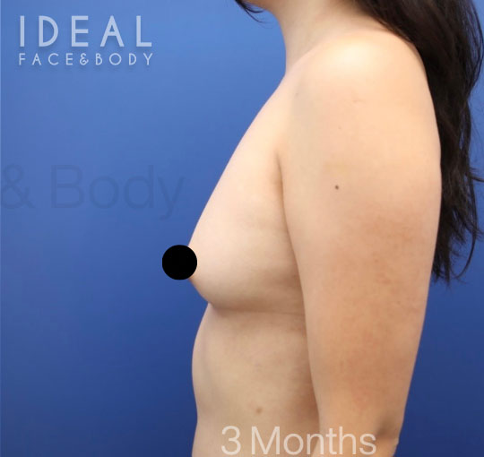 After Image: Awake Breast Fat Transfer | Raise Your Cup® - left-side