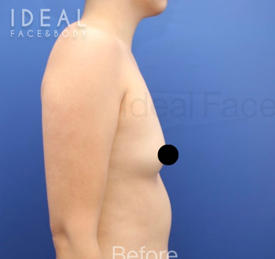 Before Image: Awake Breast Fat Transfer | Raise Your Cup® - right-side