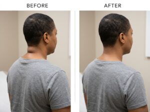 buffalo hump liposuction