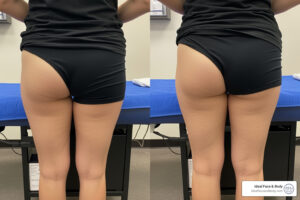 Inner thigh fat reduction surgery