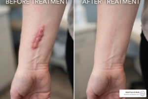 hypertrophic scar removal
