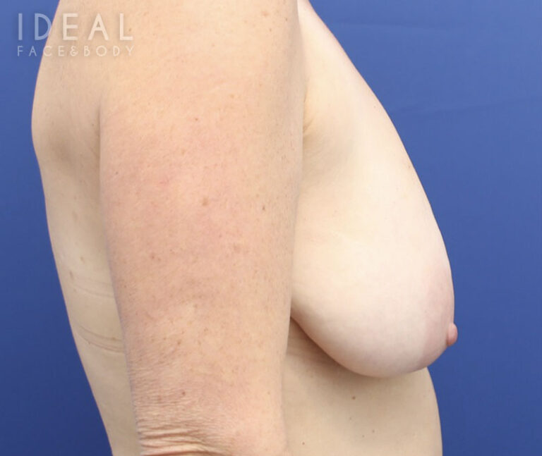 Before Image: Awake Breast Lift® | Mastopexy | Reduction - right-side