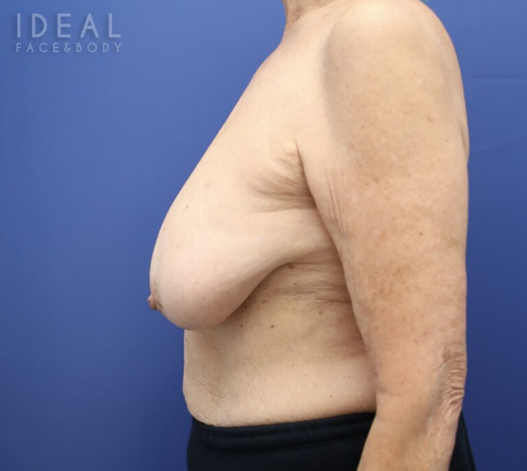 Before Image: Awake Breast Lift® | Mastopexy | Reduction - left-side