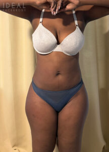 After Image: Awake 360 Liposuction | PRECISION SCULPT®