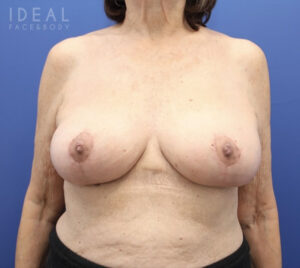 After Image: Awake Breast Lift® | Mastopexy | Reduction