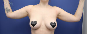 Before Image: Awake Arm Liposuction | PRECISION SCULPT®