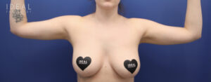 After Image: Awake Arm Liposuction | PRECISION SCULPT®