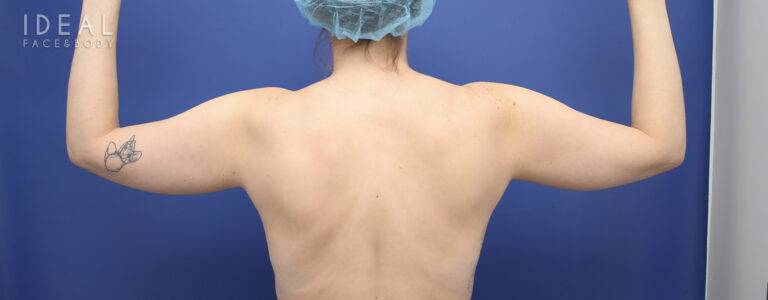 Before Image: Awake Arm Liposuction | PRECISION SCULPT® - back