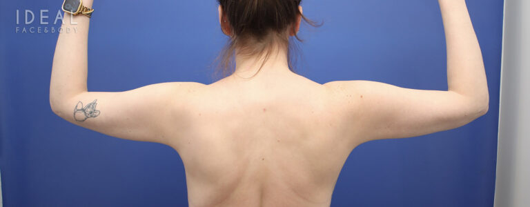 After Image: Awake Arm Liposuction | PRECISION SCULPT® - back