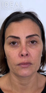 Before Image: CO2 Laser for Facial Rejuvenation