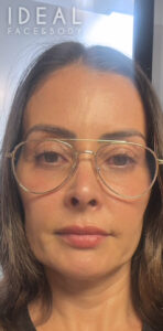 After Image: CO2 Laser for Facial Rejuvenation
